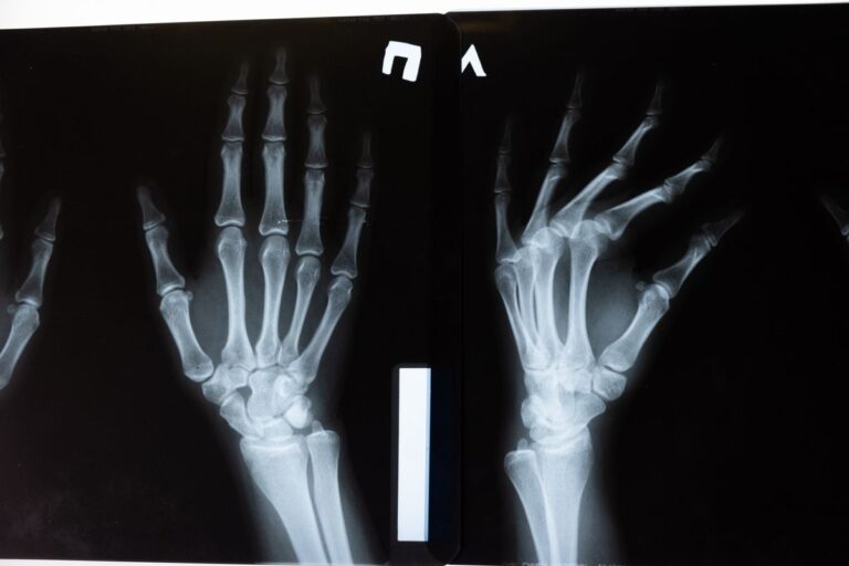 featured-bone
